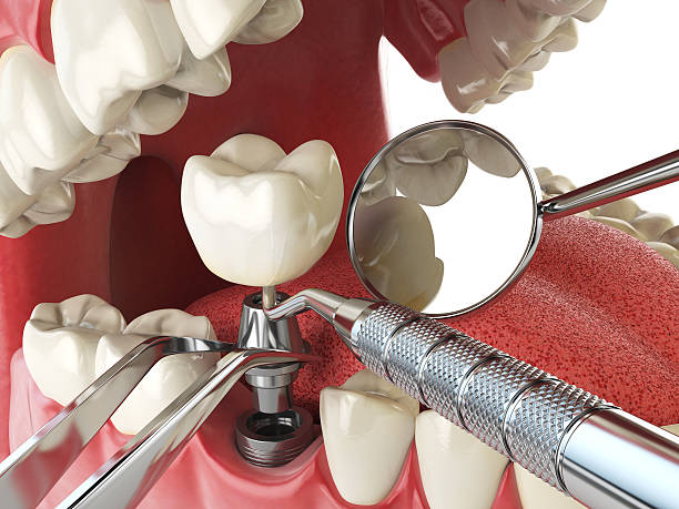 Best Emergency Root Canal Treatment in Vernon Center, NJ
